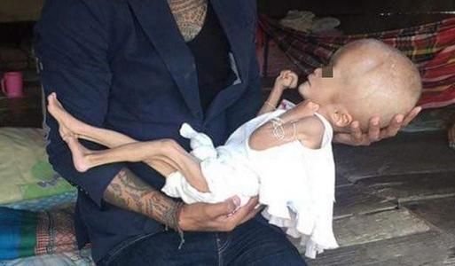 喝毒奶粉的孩子现在怎么样了,喝毒奶粉长大的孩子现在怎样了