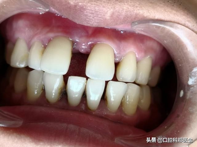 牙周炎引起门牙缝隙变大吗,牙周炎导致门牙往外突特别严重