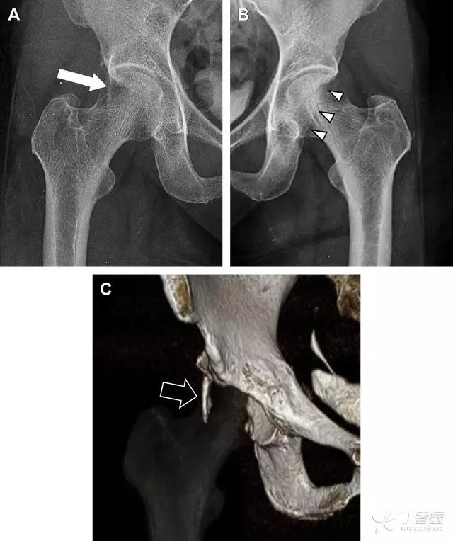 值夜班急救措施,放射科容易漏诊的骨折
