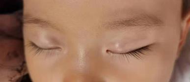 一岁宝宝长了霰粒肿多久能自愈,刚满1周岁宝宝霰粒肿怎么办