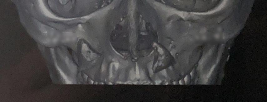 膨体垫鼻基底能管一辈子吗,膨体垫鼻基底要打钉子吗