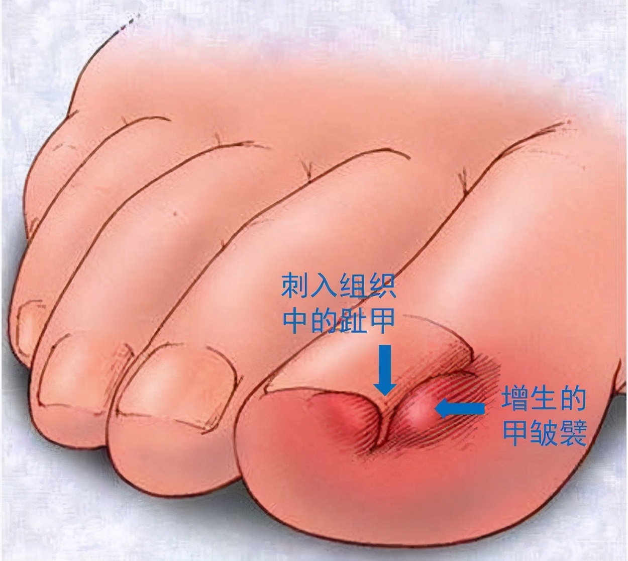 甲沟炎好治吗是什么原因引起的,甲沟炎特别严重的情况下怎么办