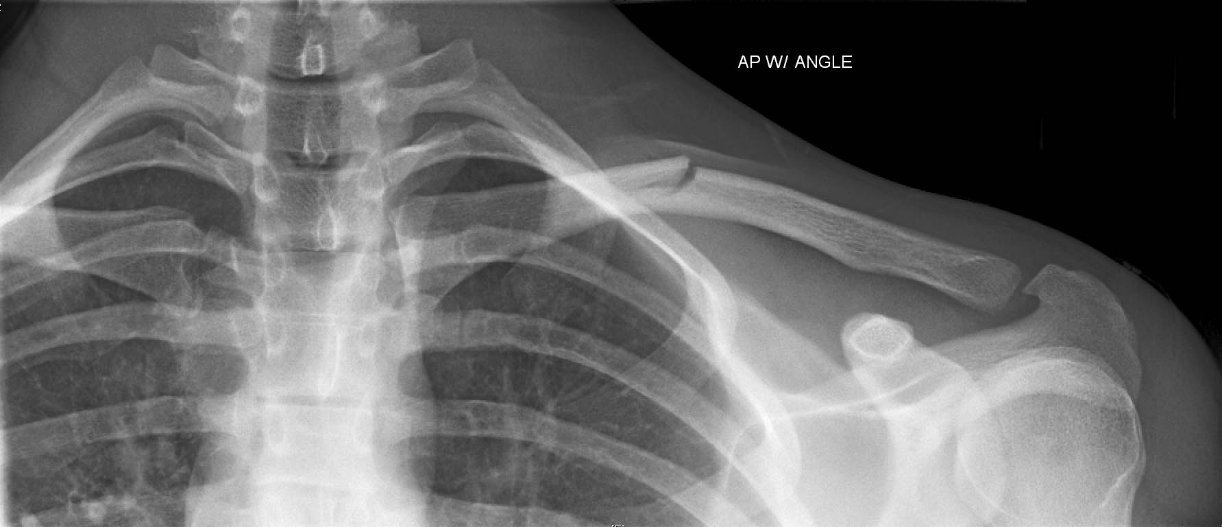 新生儿锁骨骨折原因有哪些,左侧锁骨骨折的感染的护理目标