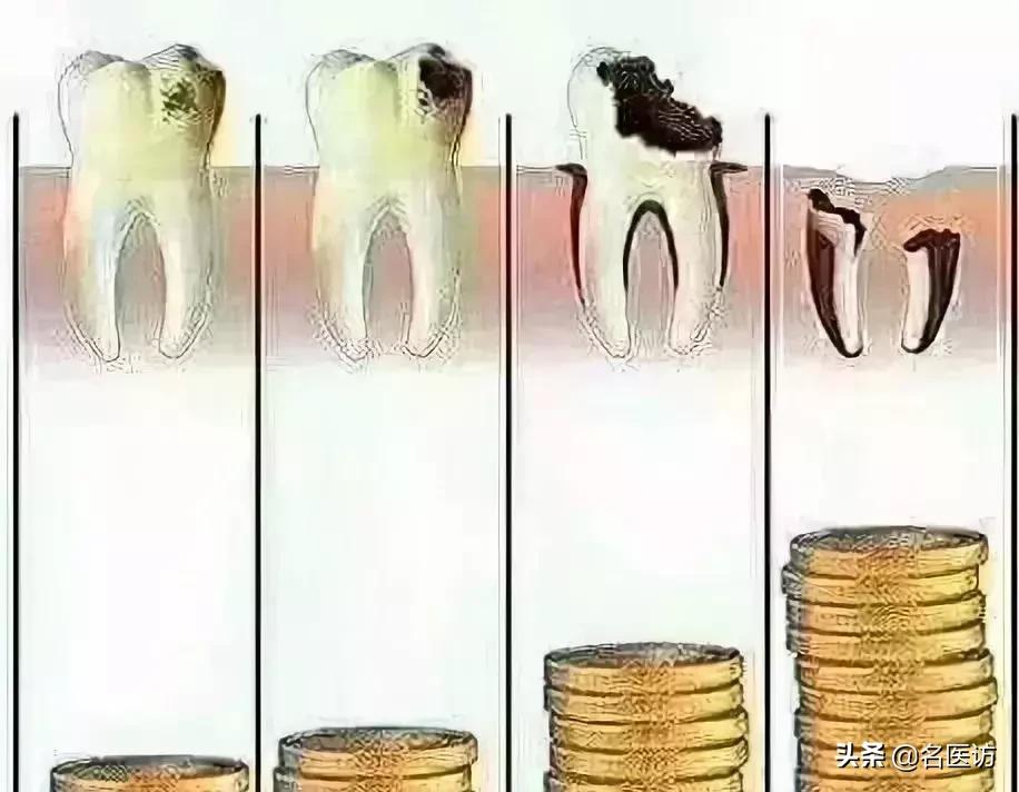 如果蛀牙已经烂了怎么办,如果蛀牙只剩一点牙根了咋办