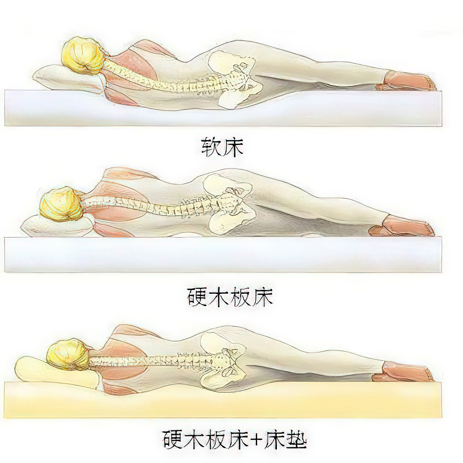 腰椎生理性曲度变直怎么治疗恢复,如何有效的避免腰椎曲度变直