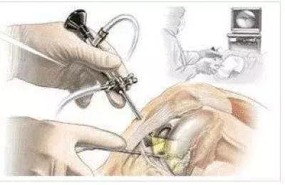 专家解答骨关节炎6大常见问题,解决膝关节炎必须要知道的4件事