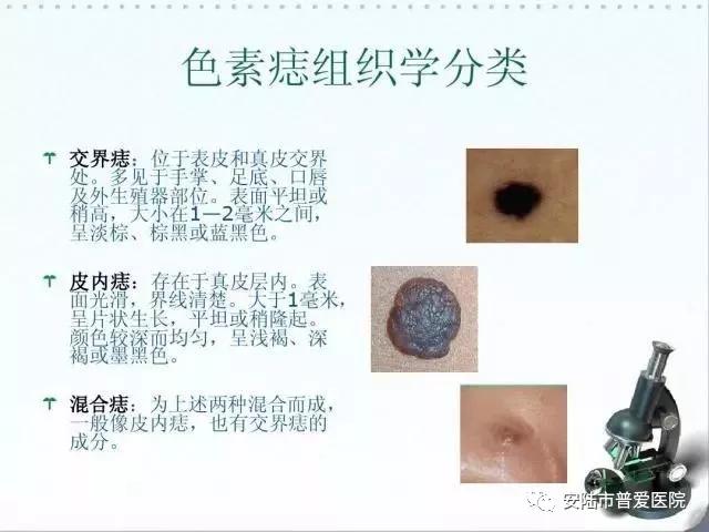 一颗痣的隐患,一颗痣的烦恼