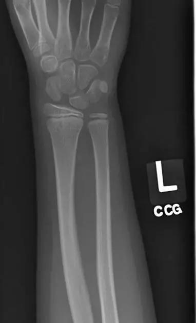 特殊骨折类型,特殊骨折体征