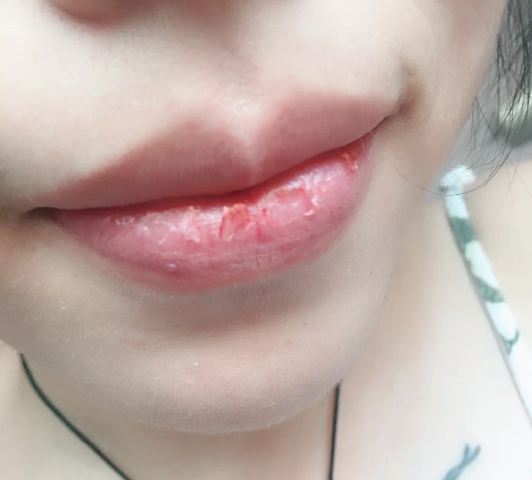 嘴唇有唇纹该如何淡化,嘴唇干唇纹深怎么改善