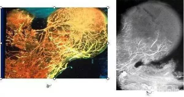 股骨头坏死早期介入和干预,股骨头坏死早期介入治疗