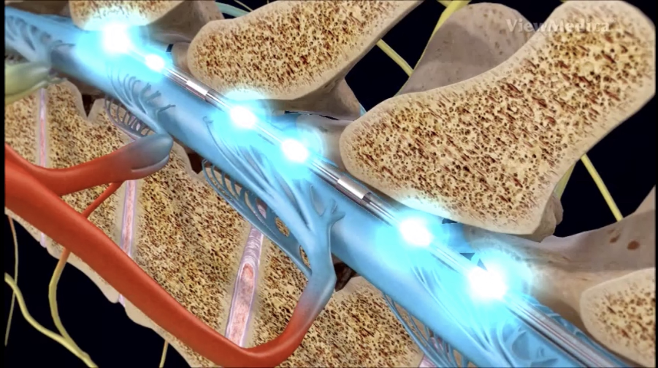 坐骨神经痛是糖尿病引起的吗,被糖尿病并发症吓到