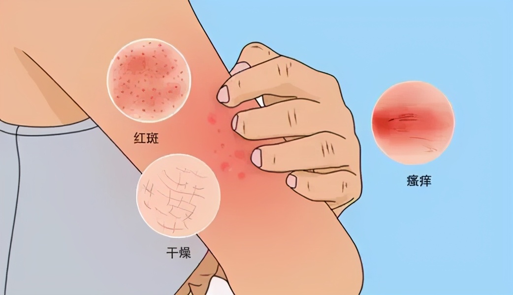 有湿疹不得癌症吗,隐性湿疹