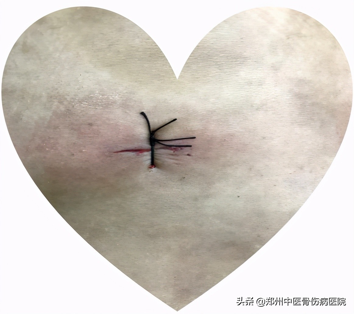 腰腿痛治半年多没效果,腰腿痛有做小针刀好的吗