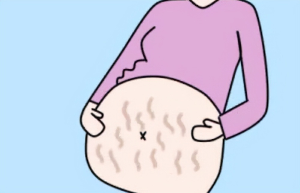 怀孕长妊娠纹了怎么补救,妊娠纹修复真的可以祛除妊娠纹吗