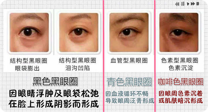 黑眼圈最快消除方法不用愁,黑眼圈去除最有效的方法推荐