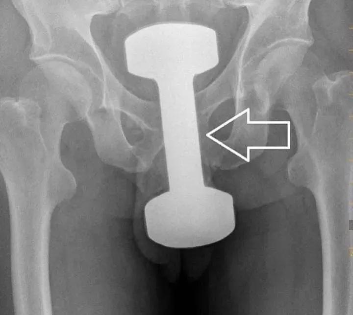 男子体内塞电线,男子嘴里塞了灯泡