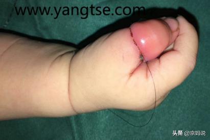 生娃之后掉头发是什么原因,生完宝宝1年掉头发是越来越严重