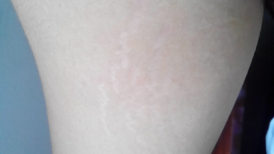 肥胖纹和妊娠纹消除方法,肥胖纹妊娠纹怎么消除