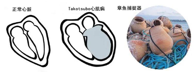 悲伤型心脏病,心脏病最怕的是心情吗