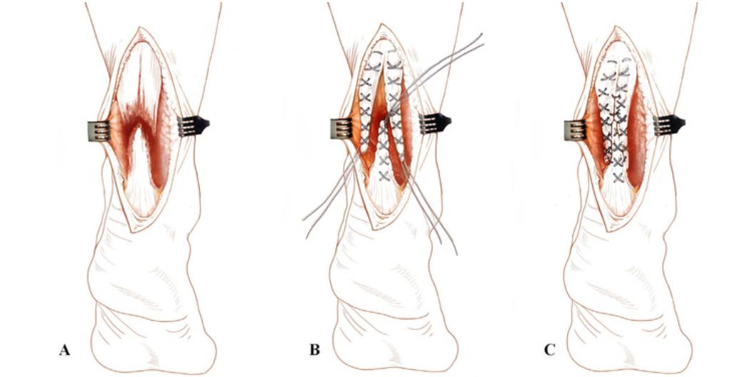 球星谈论科比跟腱断裂,球星跟腱断裂代表着什么