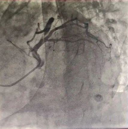北京积水潭医院心内科成功开展医疗新技术！准分子激光冠脉消蚀术与冠脉旋磨术治疗冠脉钙化病变