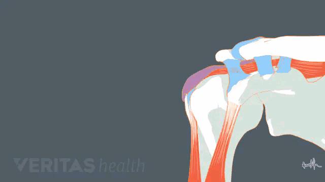 肩周炎肩膀疼是什么原因造成,肩周炎导致的肩膀疼痛怎么缓解