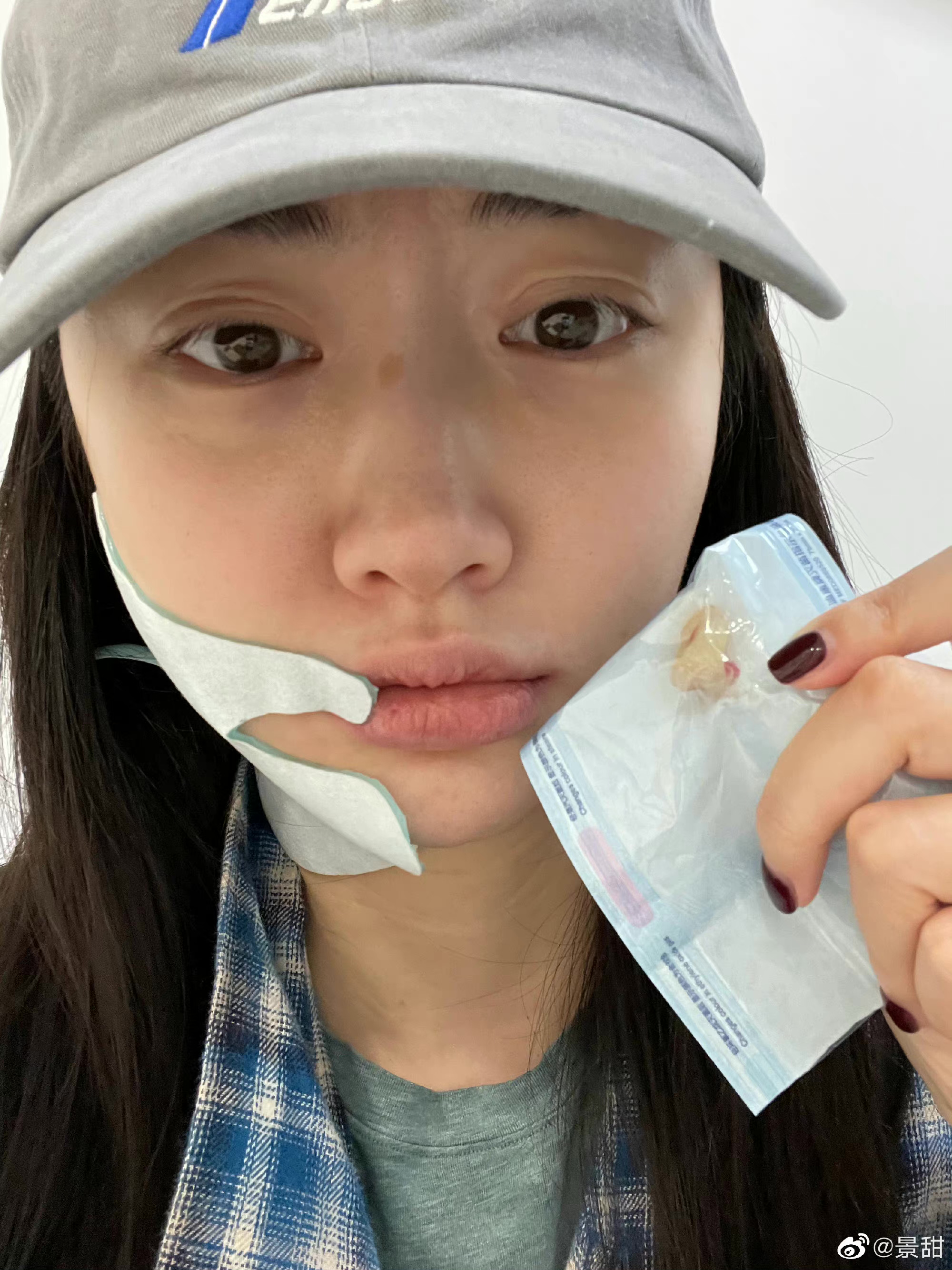 景甜拔牙后自拍照,景甜拔牙后的自拍照