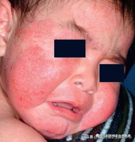 儿童湿疹和痱子要分清楚,成人痱子和湿疹如何分别