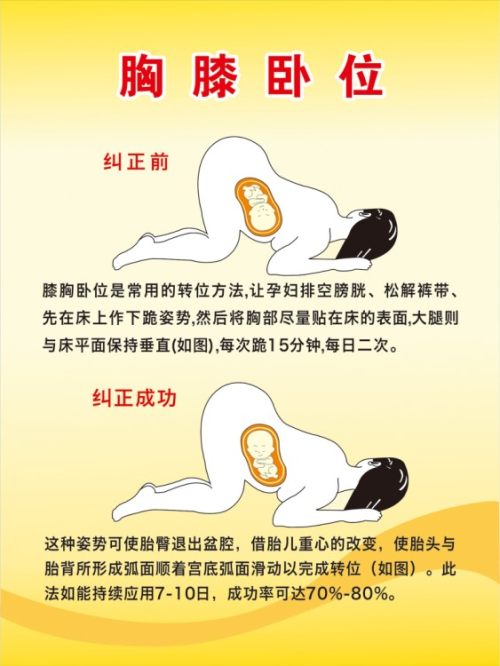 孕28周胎位不正熏艾条有用吗,胎位不正怎么办准妈妈这样来纠正