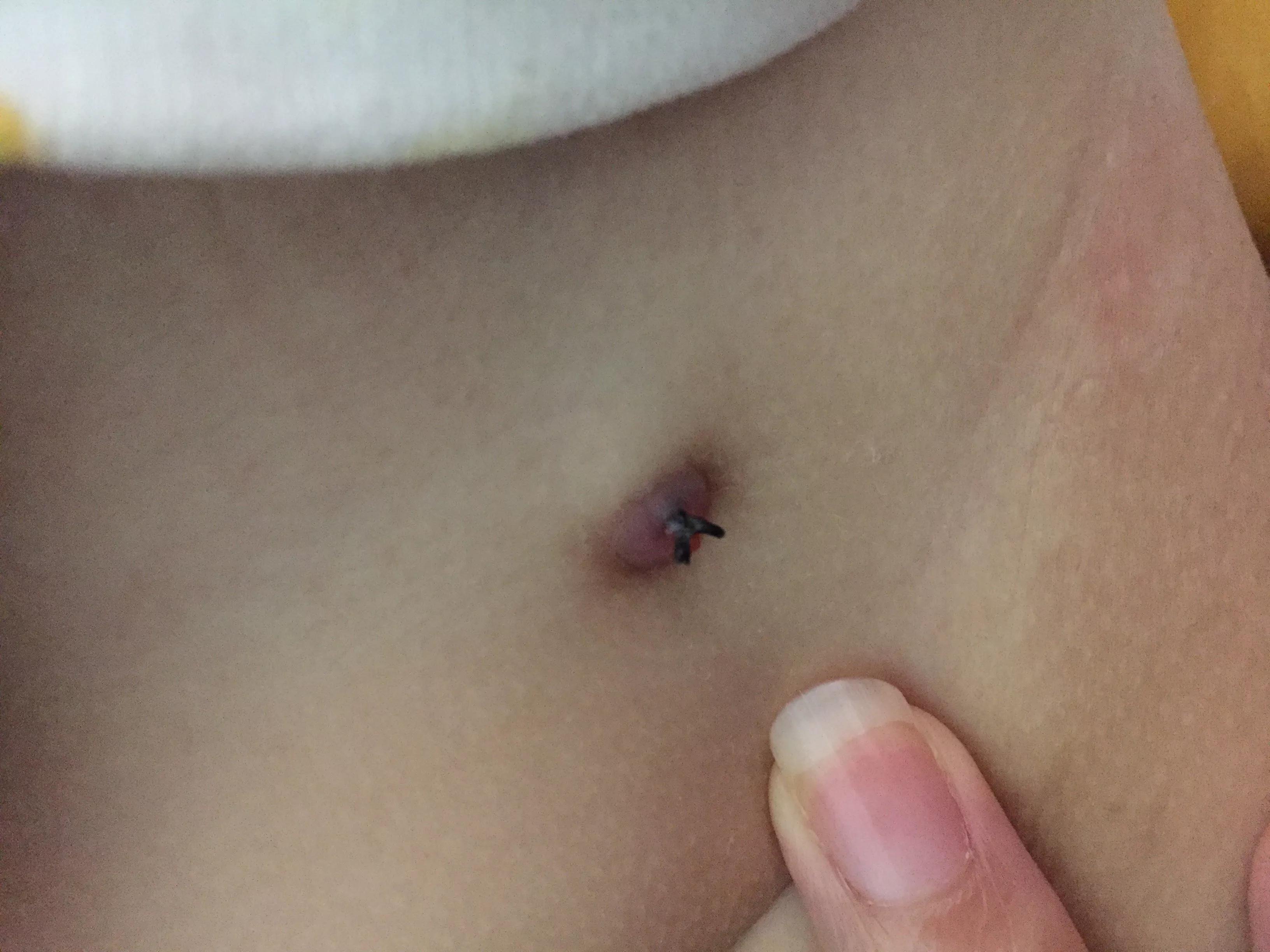 手术后一个月还有线头正常吗,手术后四个月刀口疼正常吗