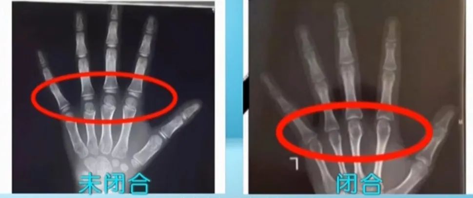 健康干货|父母160+，为啥林书豪身高191？