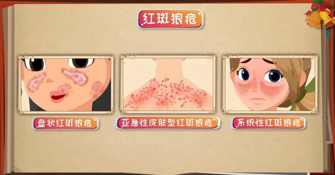 干细胞治疗红斑狼疮最新消息,红斑狼疮自体干细胞移植效果