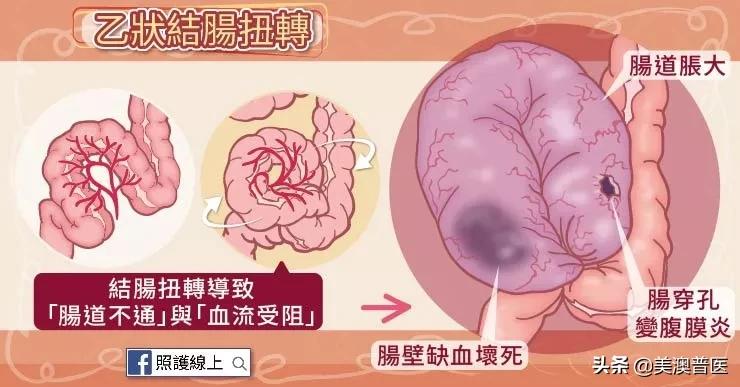 乙状结肠扭转原因,乙状结肠扭转病例