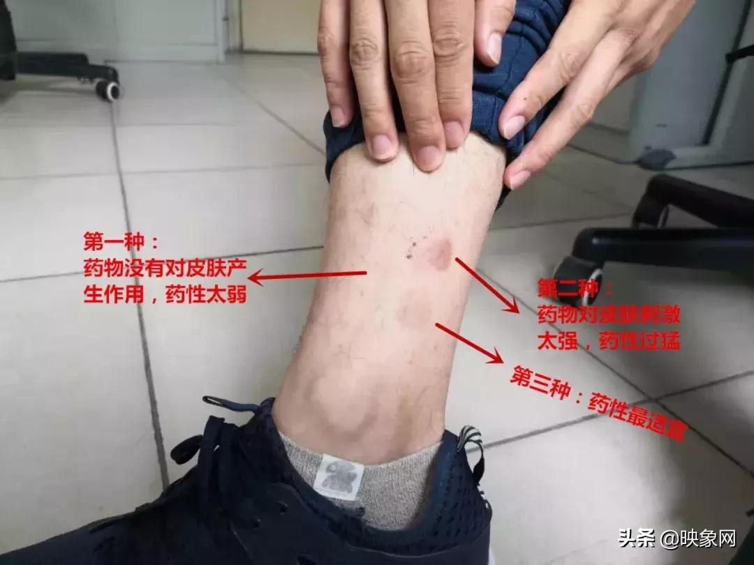 郑州三伏贴哪家好,郑州三伏贴有效吗