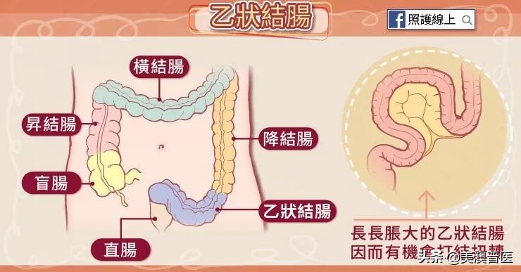 乙状结肠扭转原因,乙状结肠扭转病例