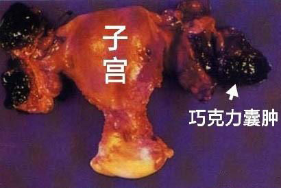 巧克力囊肿手术的利弊,巧克力囊肿的相关知识