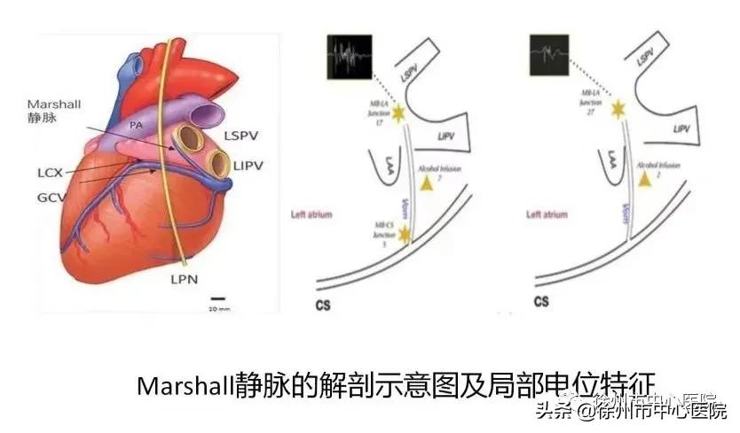 多年饮酒房颤戒酒后几年能恢复,多年房颤中医能治吗