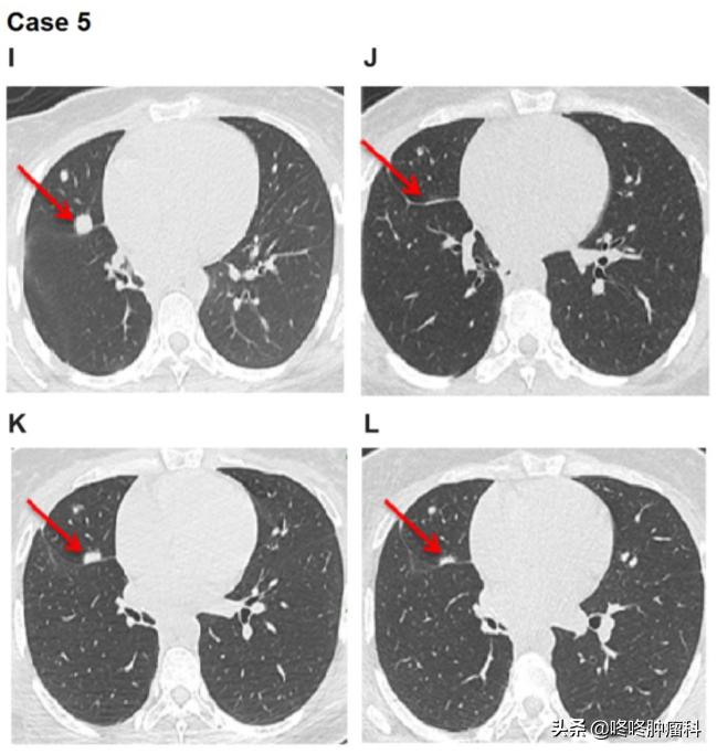 治癌症的靶向药有副作用吗,抗癌靶向药肺癌