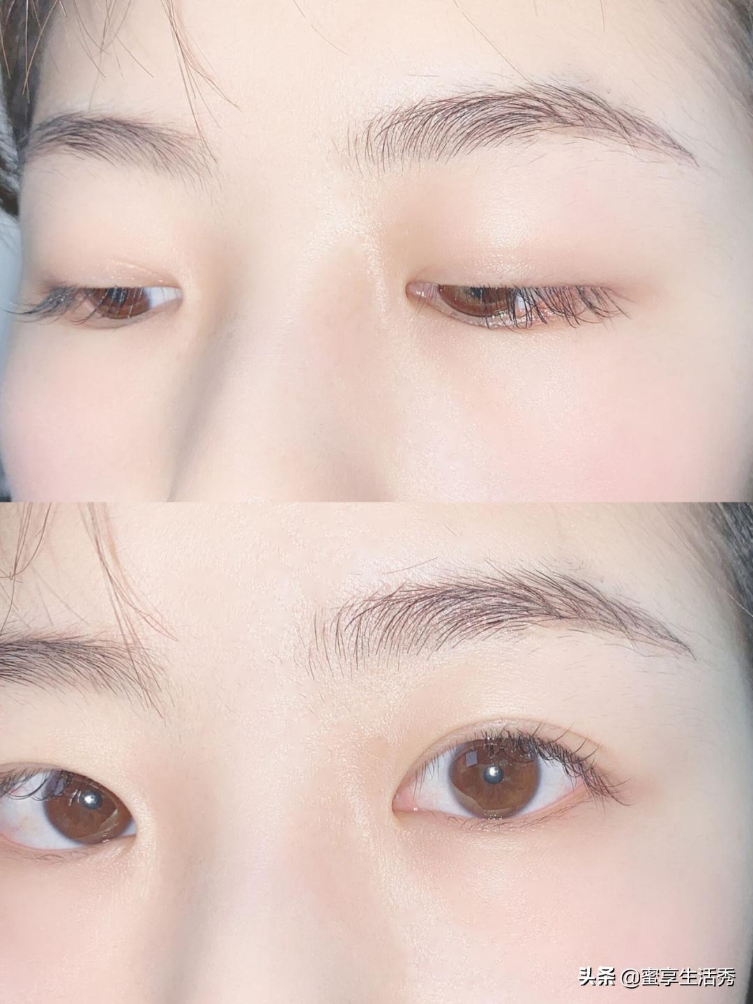 内双眼皮手术变外双效果,内双眼皮怎么变外双按摩最有效