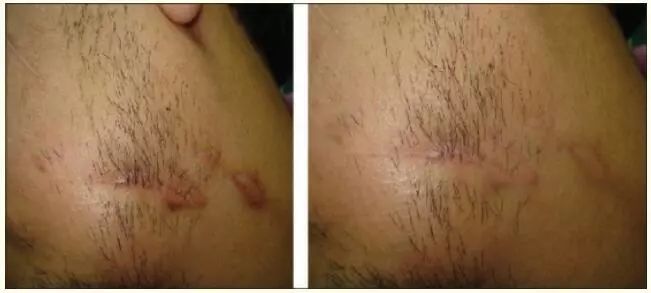 疤痕护理软膏可以修复疤痕吗,祛疤痕药能彻底祛疤吗