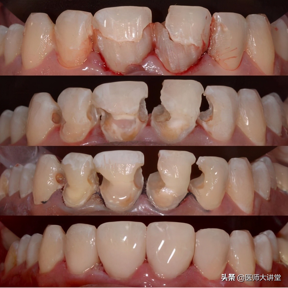 活动假牙排牙制作,下牙义齿制作