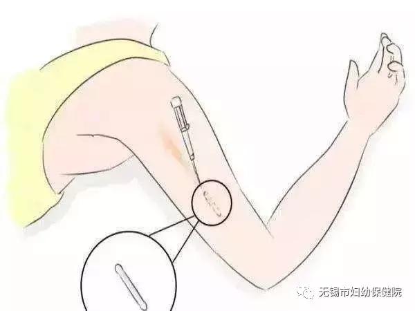 皮下埋植法避孕陕西哪里可以做,避孕节育新技术