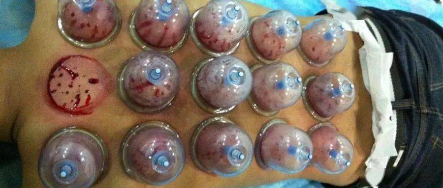 细谈针灸治疗上的一些原则问题