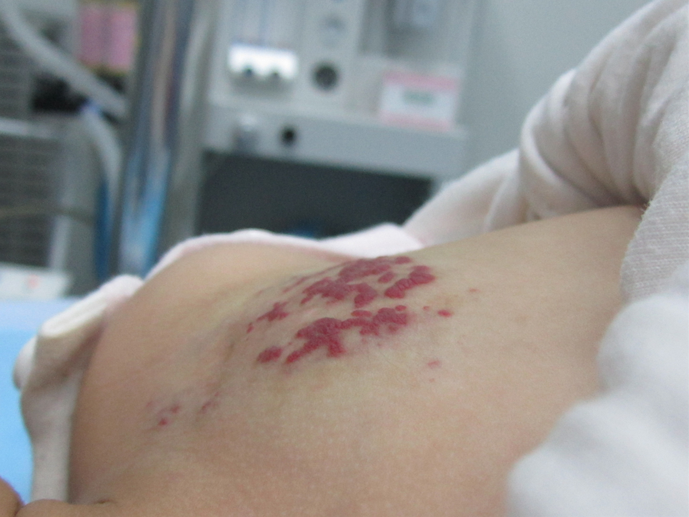 乳房血管瘤用什么方法治最好,乳房上有樱桃状血管瘤怎么治