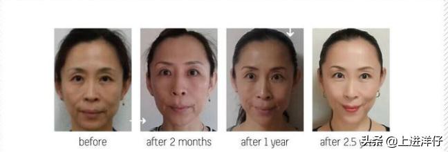 皮肤松弛下垂的最佳锻炼修复方法,皮肤松弛下垂怎么抗衰老呢