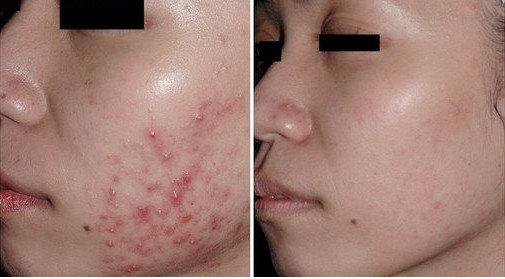 刷果酸能祛斑吗,果酸可以嫩肤吗