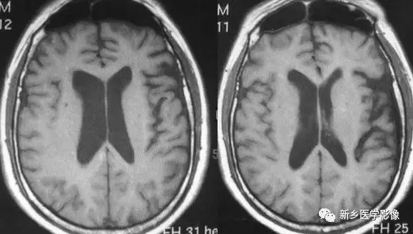 脑室影像学表现,脑室占位影像