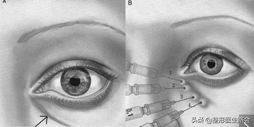 玻尿酸填充泪沟20多天了还有淤青,填充眼袋泪沟的淤青怎么才会消除