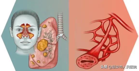 治疗肉芽肿性血管炎哪家医院好,嗜酸性肉芽肿性血管炎哪家医院好