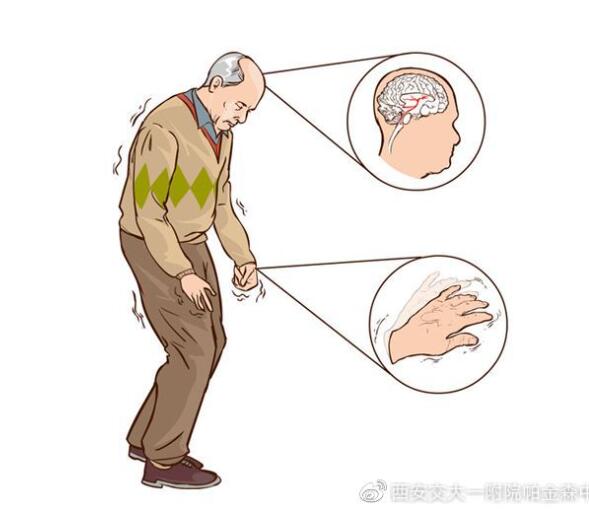 帕金森病会不会引起胃不适,帕金森药对胃肠道有伤害怎么办